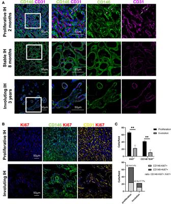 CD146+ mural cells from infantile hemangioma display proangiogenic ability and adipogenesis potential in vitro and in xenograft models